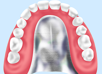 金属床義歯