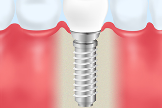 インプラント