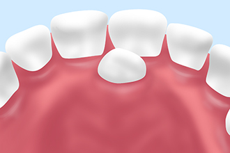 過剰歯の抜歯