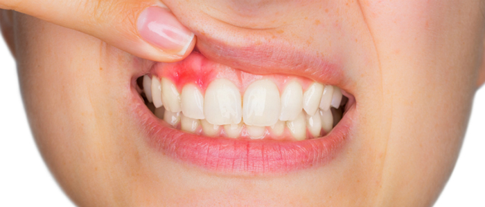 歯周病は成人の80%が予備軍と言われています
