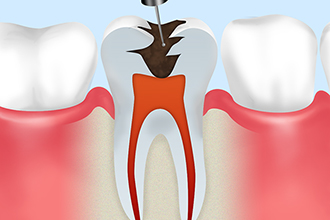 根管治療で歯を残す治療も行っています